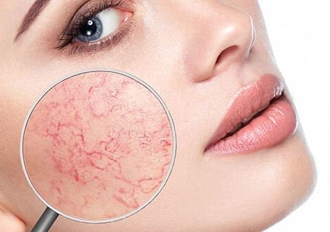 Rosazea-Trigger:  Auslöser erkennen und minimieren