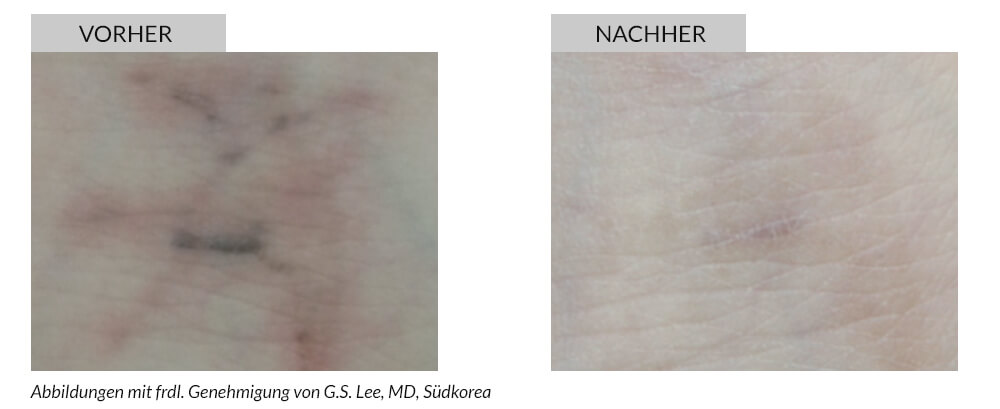 Tattooentfernung Vorher Nachher