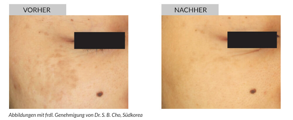 Tattooentfernung Vorher Nachher