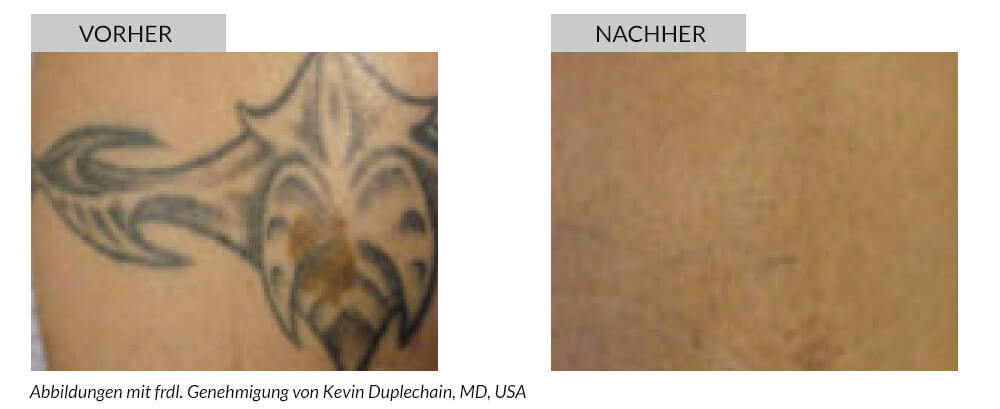 Tattooentfernung Vorher Nachher