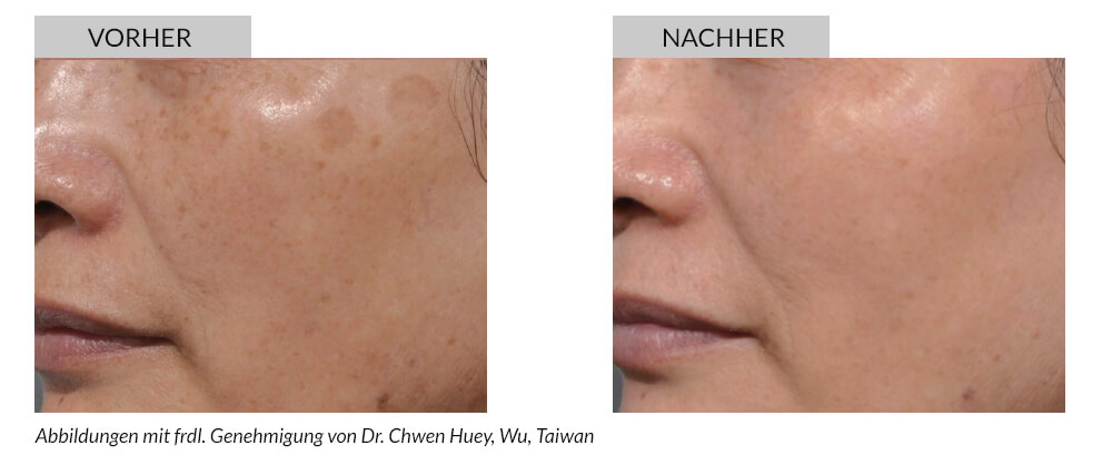 Tattooentfernung Vorher Nachher