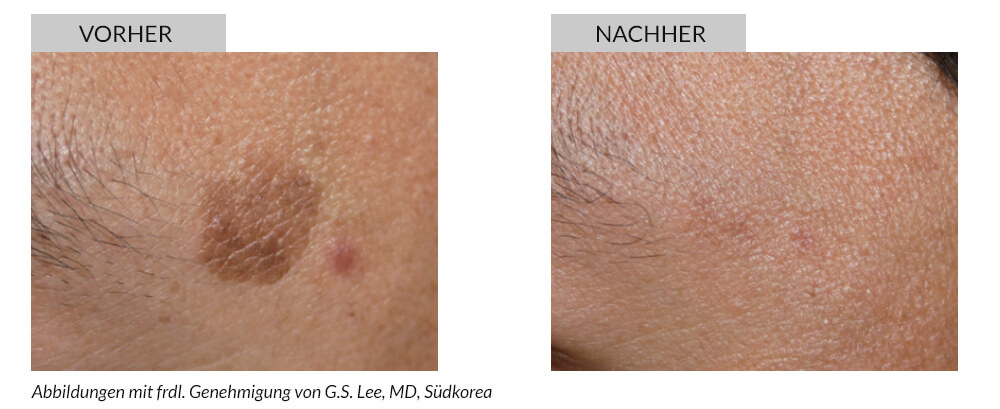 Tattooentfernung Vorher Nachher