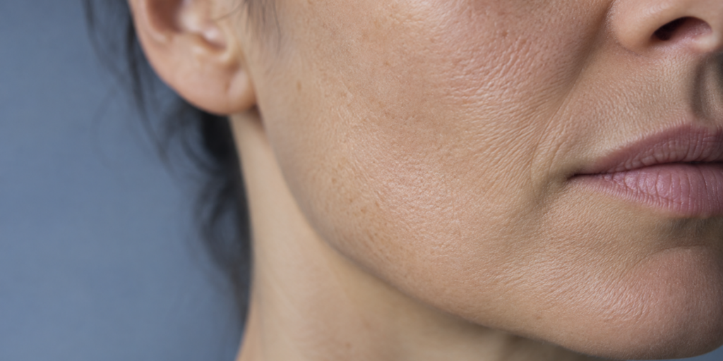 Biostimulation statt Filler: Hautqualität statt Volumen
